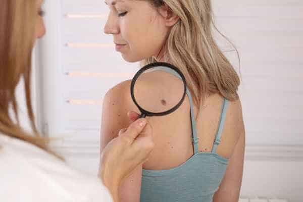 What Are Traditional Skin Lesion Removal Methods Chipping Norton?