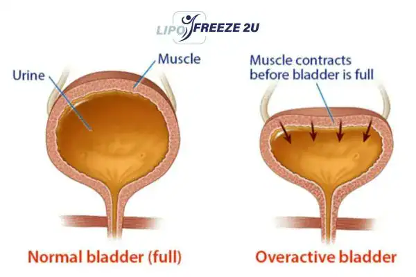 diagram of overactive bladder treatment Chipping Norton