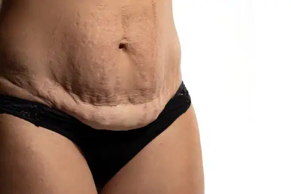 loose skin after weight loss injections Chipping Norton