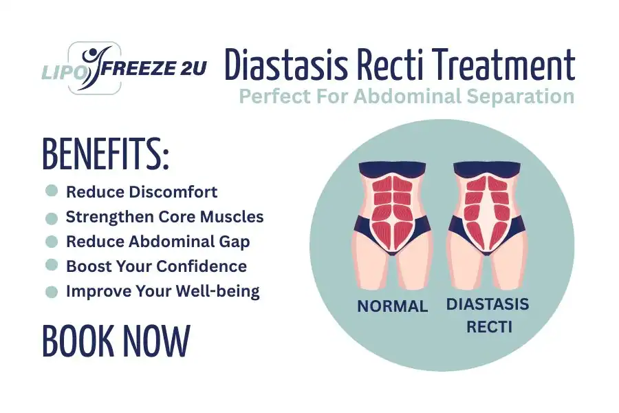 Benefits of body toning treatment Chipping Norton for Diastasis recti