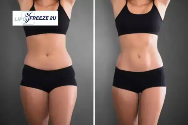 How Can LIPO FREEZE 2U Support Your Post-Pregnancy Body Recovery Chipping Norton?