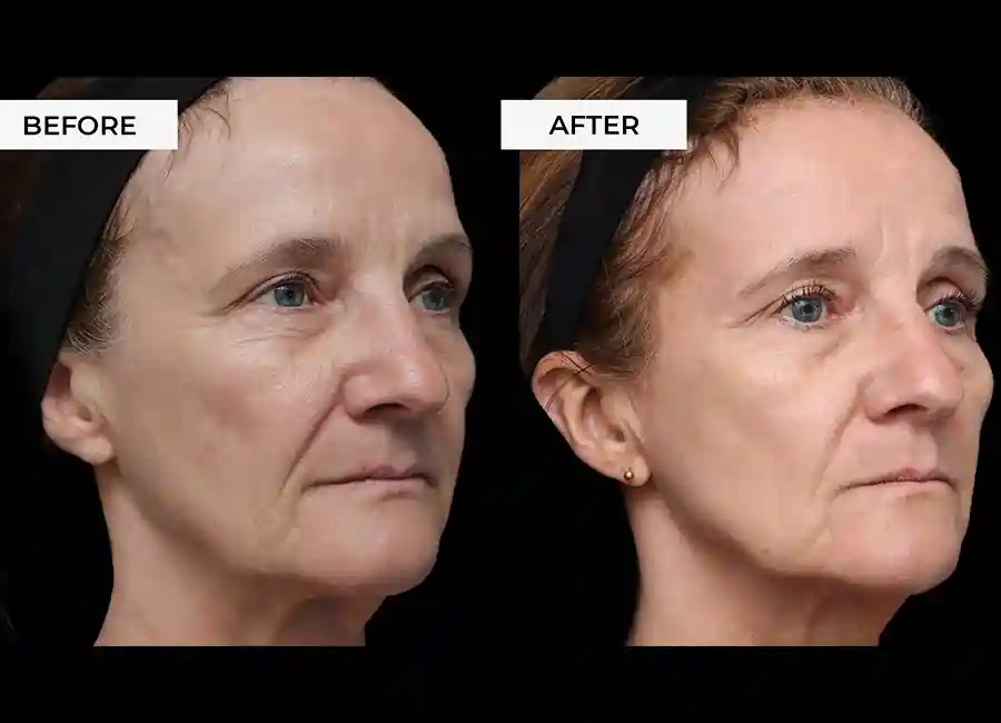 How Many RF Microneedling Sessions Will You Need to See a Difference Chipping Norton?