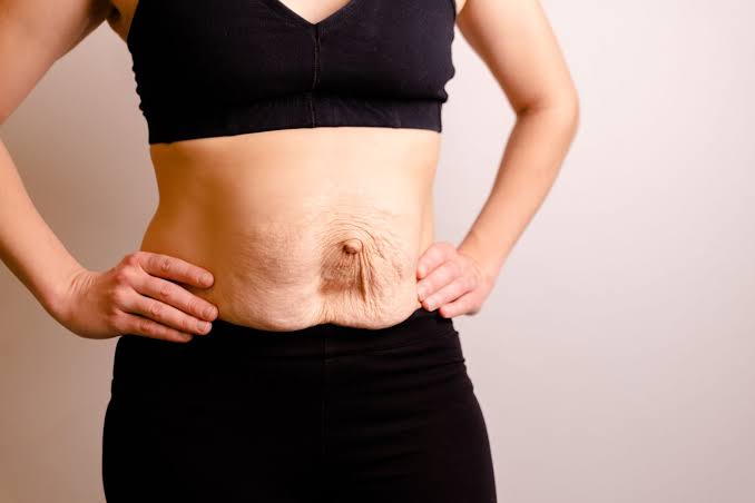 Is Surgery Really the Only Way to Repair Diastasis Recti Chipping Norton?