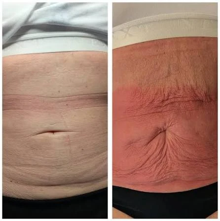 How Does RF Microneedling Improve Crepey, Thin and Uneven Skin Texture Chipping Norton?