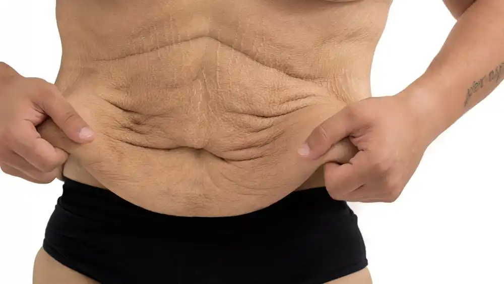 Why Does Weight Loss Medication Leave Some People With Loose or Sagging Skin Chipping Norton?